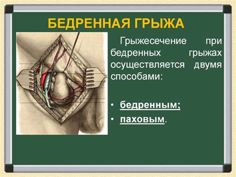 Оперативное лечение грыж - презентация онлайн