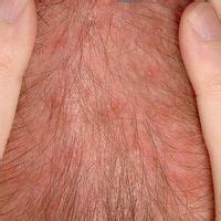 Folliculitis superficial Images - Altmeyers Encyclopedia - Department ...