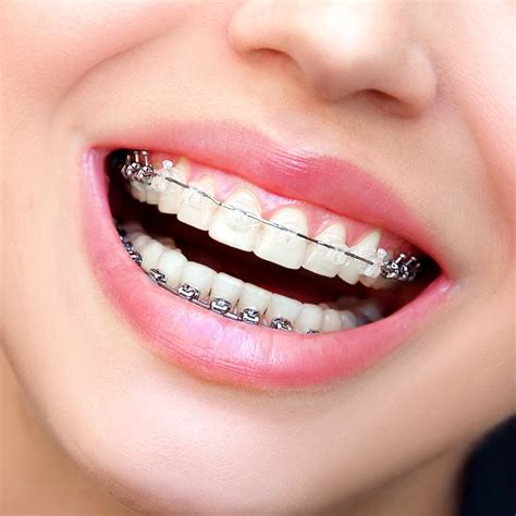 braces  wendling ortho dr lisa wendling flint mi