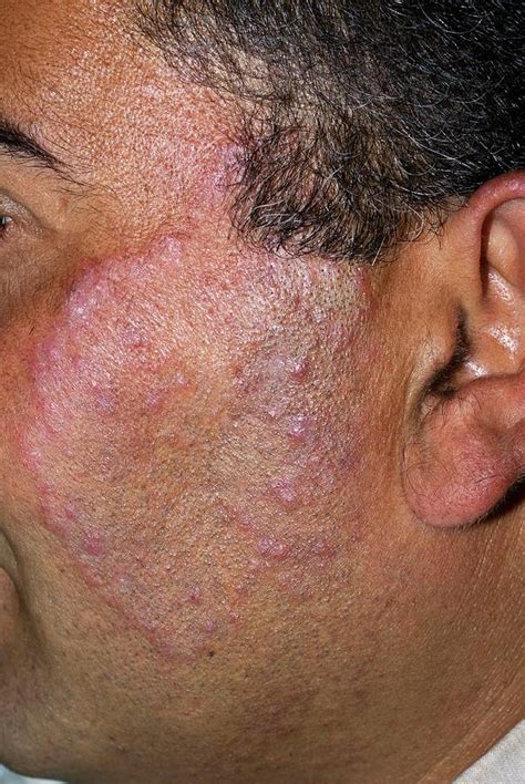 Tinea Fungal Infection On The Face Photograph by Dr Harout Tanielian ...