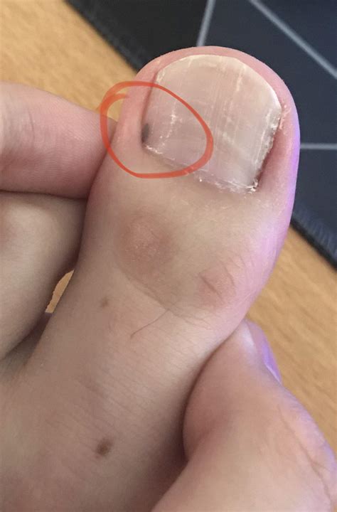 Black spot on corner of toenail? : r/DiagnoseMe