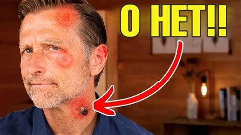 Как предотвратить боррелиоз (болезнь Лайма)?🧐 - YouTube