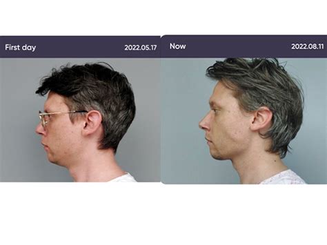 Souirensu It Works: See the Amazing Before & After Results - pg6mayh