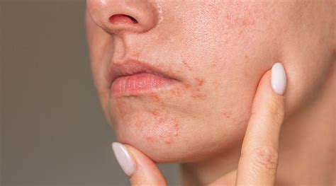 Perioral Dermatitis and Ozonated Oils: A Natural Treatment Option ...