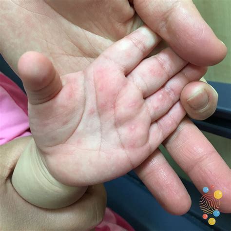 Hand Foot Mouth Rash On Mouth Discount | emergencydentistry.com