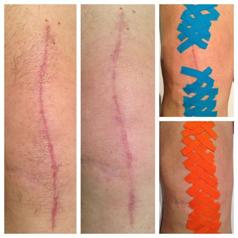 How To Break Up Scar Tissue After Knee Surgery - howsolut