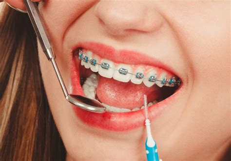 A Clear Path To Straighter Teeth: The Benefits of Clear Braces | Dental ...