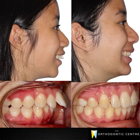 protrusive teeth alignment glen waverley  orthodontic centre