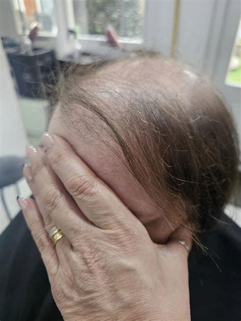 Hair Loss from Polycystic Ovaries (PCOS) - Wigs & Toppers Worcester