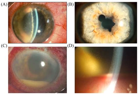 Photographs of slit lamp findings on acute anterior uveitis ...