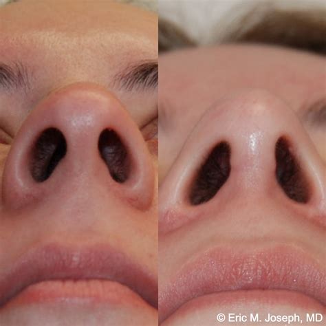Eric M. Joseph, MD | Rhinoplasty Before & After: Corrected Nasal Flaring