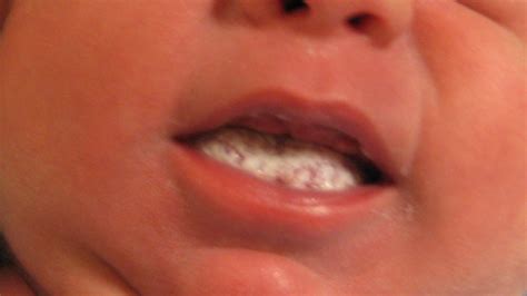 oral thrush candida remedies nyc dr alicia armitstead