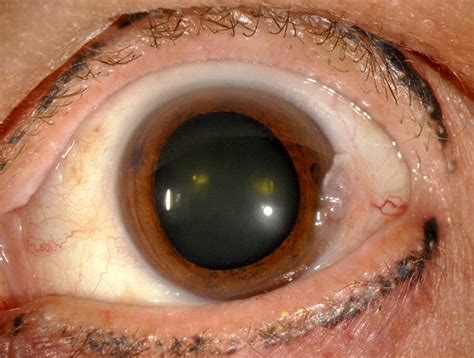 Pathology Outlines - Conjunctival intraepithelial neoplasia