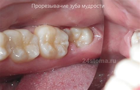 Удалили Зуб Мудрости Фото — Bluemorphotours.ru
