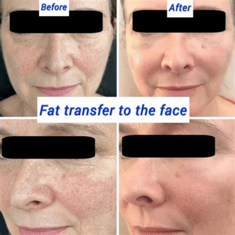Fat Transfer for Face: A More Permanent Solution for Volume Loss