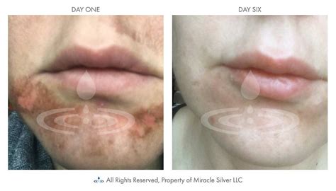 Miracle Silver Colloidal Spray