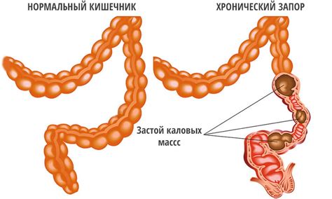 Запор при геморрое: причины, лечение запора при геморрое, диета при ...