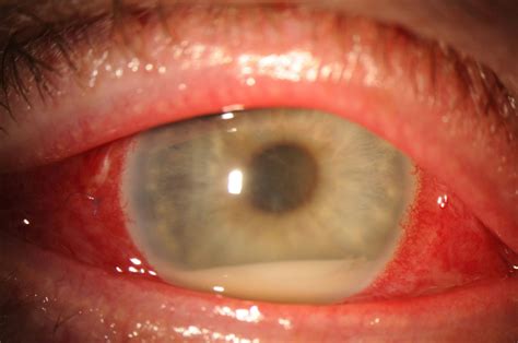 Endophthalmitis After Cataract Surgery Same Day Cataract Surgery Safe