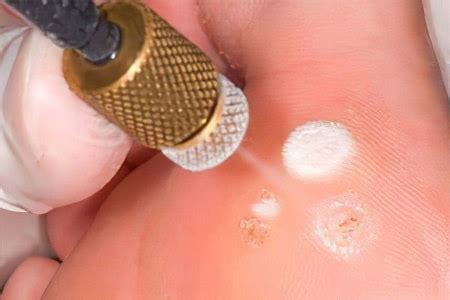 wont  warts budge  cryotherapy aesthetics medical surgery