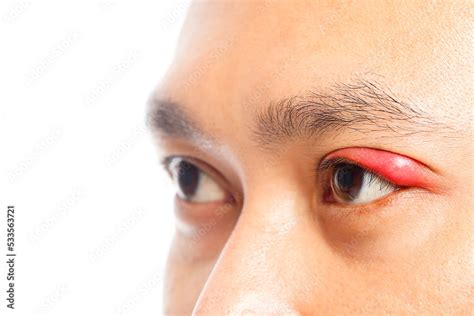 stye   people eye bacterial infection   eyelid stock photo
