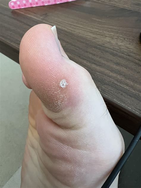 Is this a wart (on my big toe). Going to see a Derm soon. : r/Warts