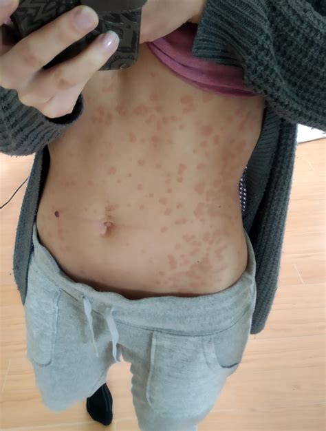 Had pityriasis like rash for more than four months from everyday