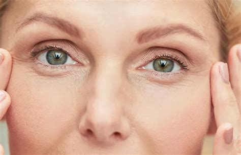 Under Eye Wrinkles: How To Get Rid Of Them?