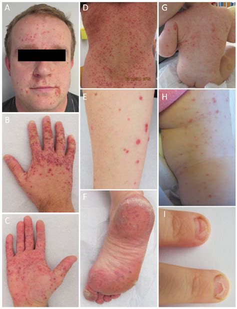 Hand Foot And Mouth Disease Adults Face