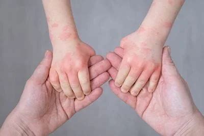 Rashes | Pediatrician In Omaha, NE | Omaha Childrens Clinic P.C,