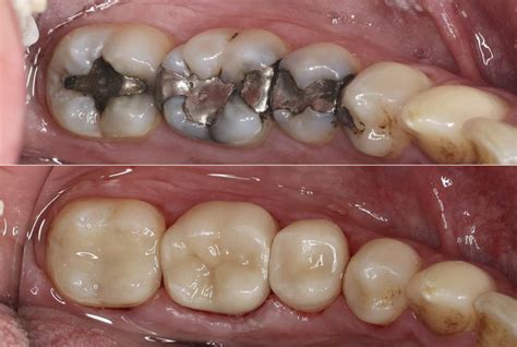 Efficient Restoration of Cracked and Fractured Teeth - Styleitaliano.org