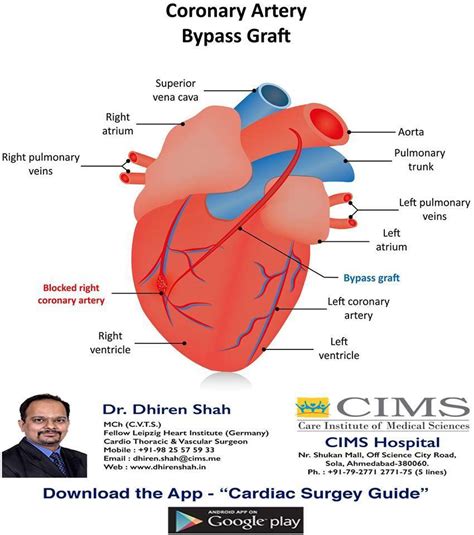 Coronary Artery Bypass Graft | The Best Cardiac Surgeon in Ahmedabad ...