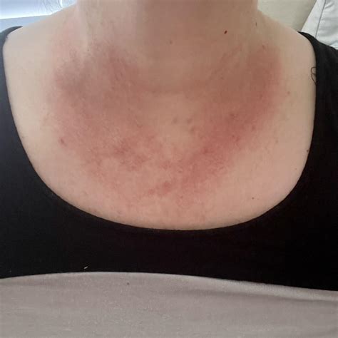 Neck Redness : r/skin