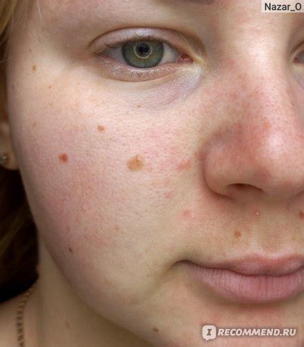 Маска для лица ARAVIA Post-Acne Balance Mask рассасывающая с ...