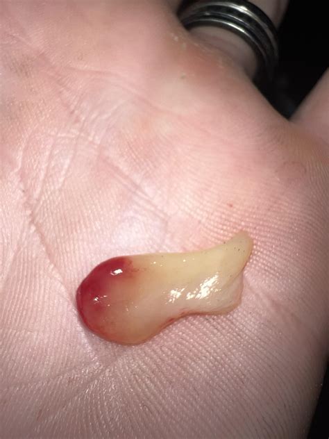 Blew a Polyp out of my nose : r/popping