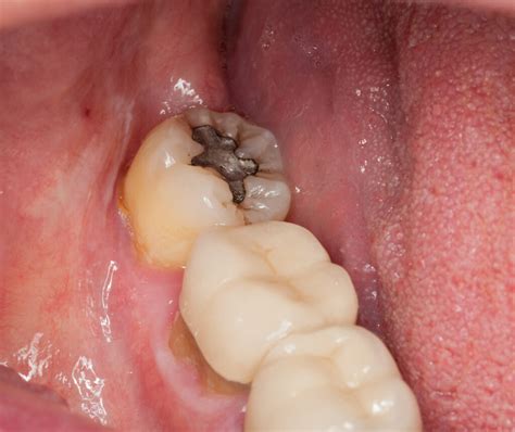 Wisdom Tooth Cavities - Brite Orthodontics