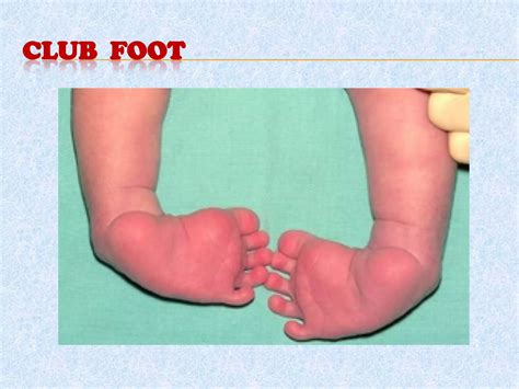 Orthopedic disorders in Children | PPTX