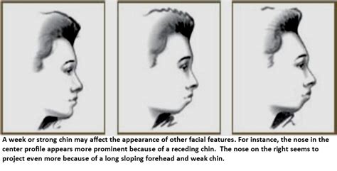 chin surgery