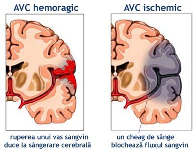 AVC. Accidentul vascular cerebral hemoragic - DrBendo.ro