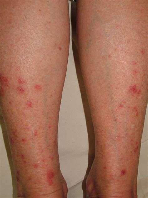 What Causes Polymorphic Light Eruption | Americanwarmoms.org