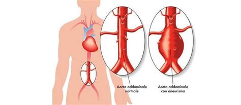 Ectasia Da Aorta O Que É - Ectasia ed aneurisma dell'aorta ascendente