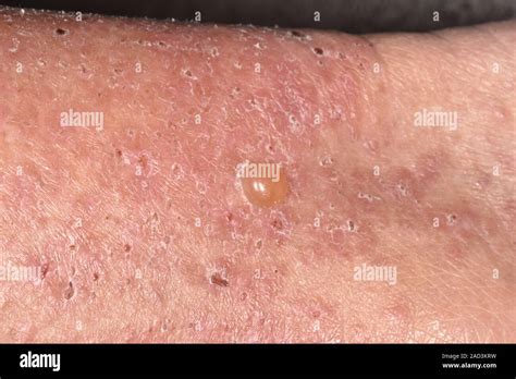 bullous pemphigoid close    blister  dry flaky skin