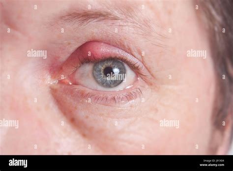 Hordeolum internum hi-res stock photography and images - Alamy