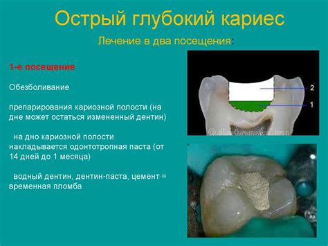 Лечение кариеса - презентация онлайн