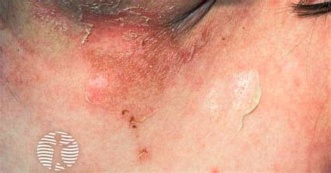 Staphylococcal scalded skin syndrome image