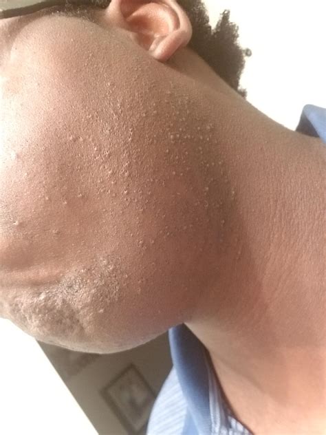 Razor Bumps And Ingrown Hairs Same Thing at Pablo Joyce blog