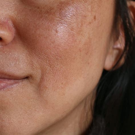 How To Get Rid Of Dark Spots On Face Beauty Crafter | atelier-yuwa.ciao.jp