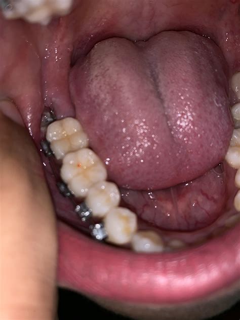 5 days post wisdom tooth extraction. Referring to the photo, is this