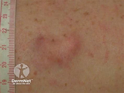 Dermatofibrossarcoma Protuberans