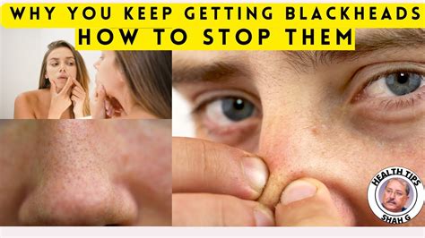 Say Goodbye to Blackheads with Unbelievable Blackhead Removal 2024 - iy2r93n