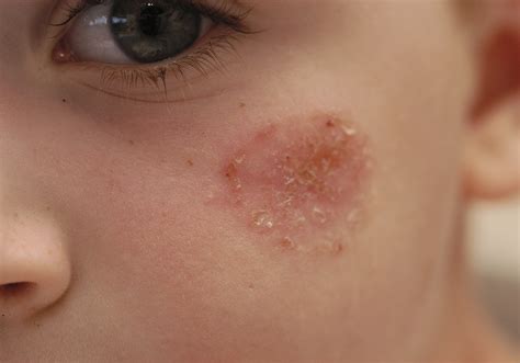 diagnosing  managing common skin diseases citizens journal